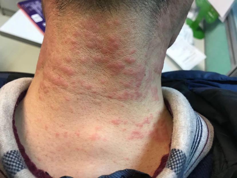 1、膏藥過敏怎么辦？