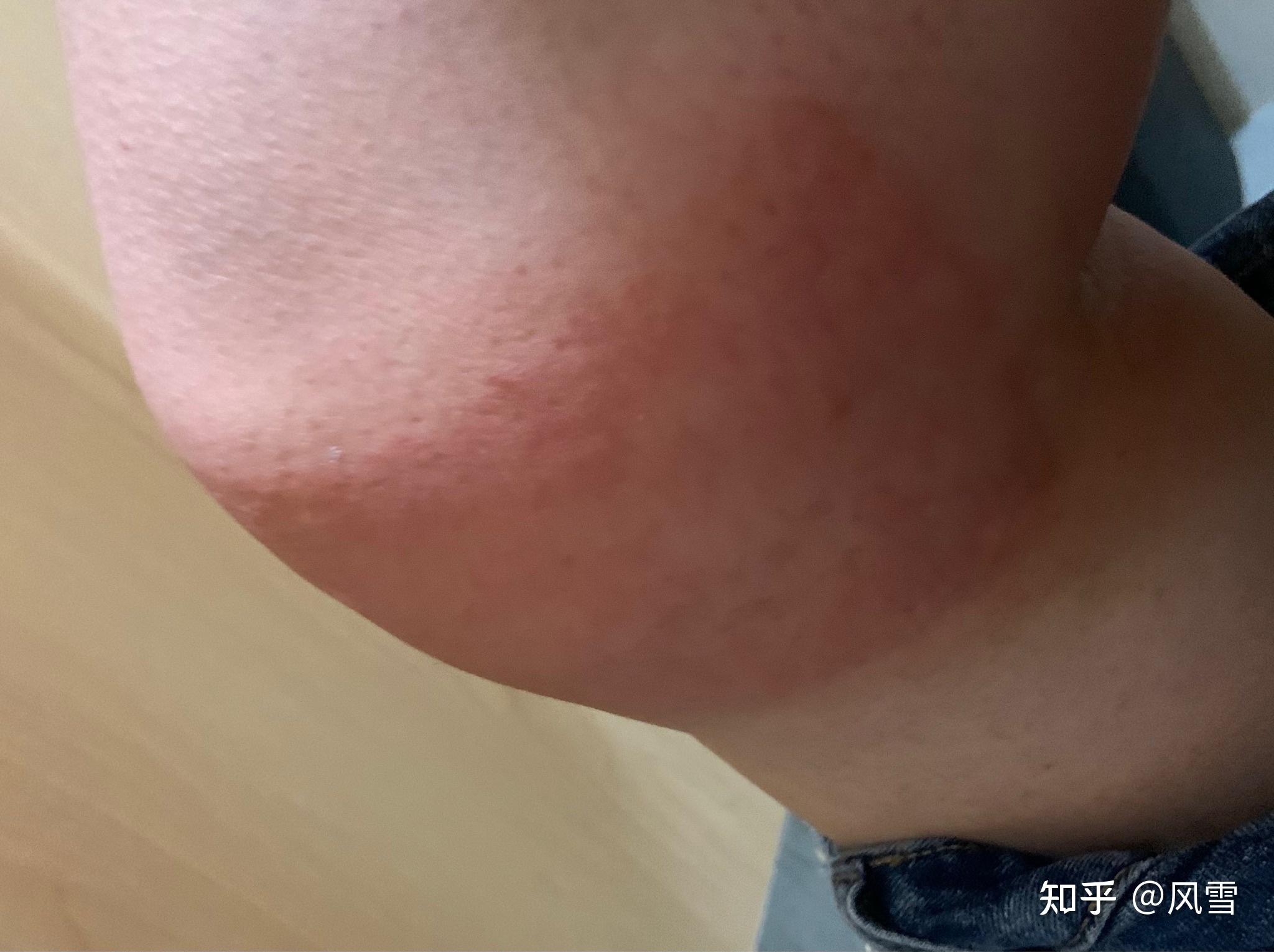 1、貼膏藥過敏癢紅腫怎么辦？