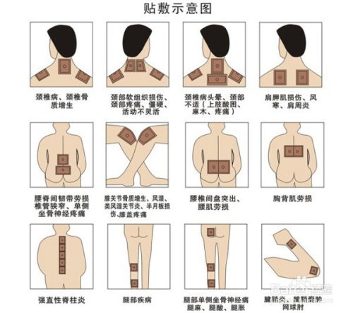 1、肩痛買什么膏藥可以貼？