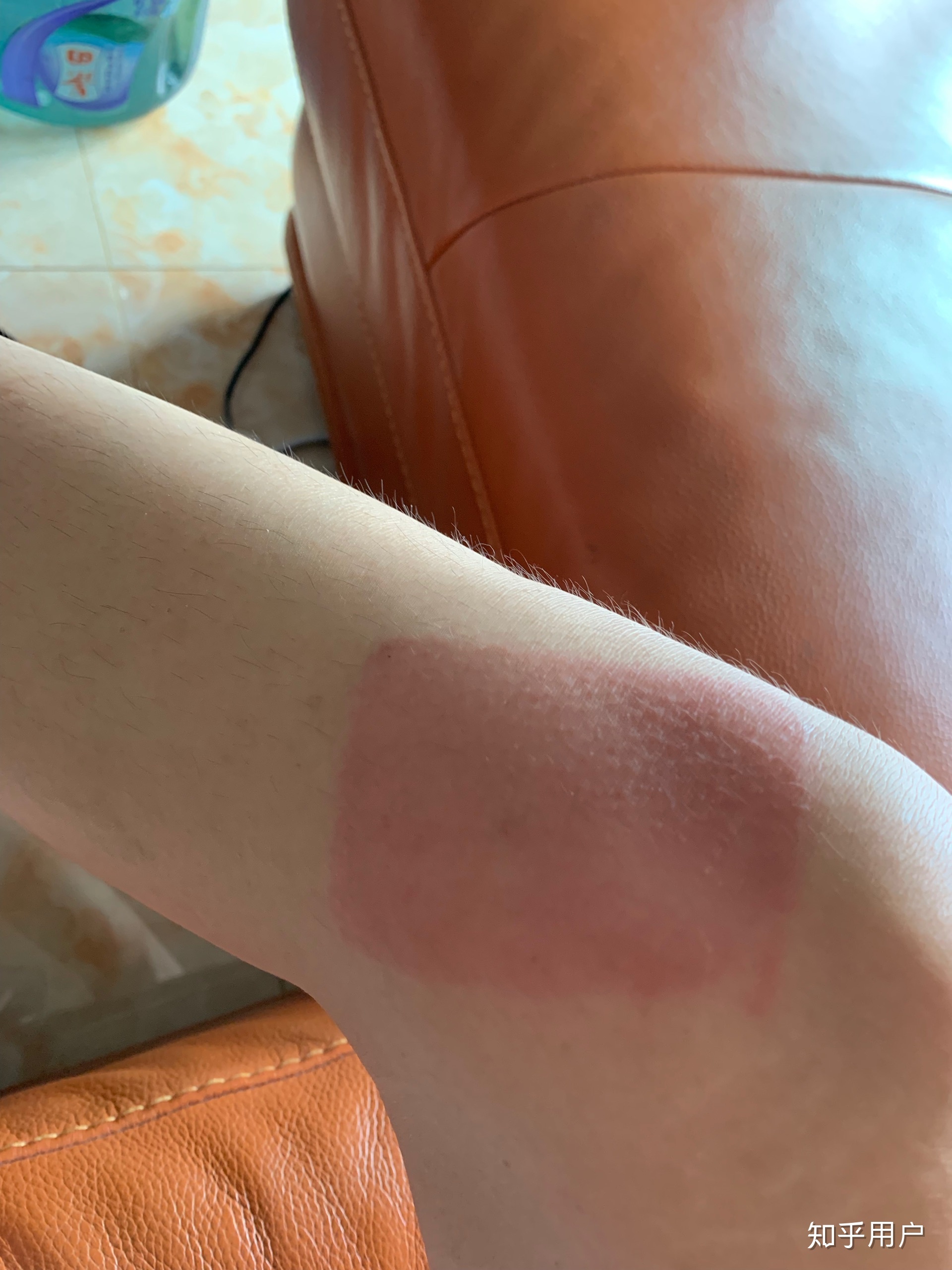 2、貼膏藥的地方有很多紅疙瘩，好不好？